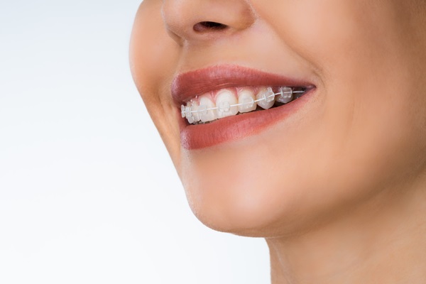 How Long Does Treatment With Clear Braces Normally Take?