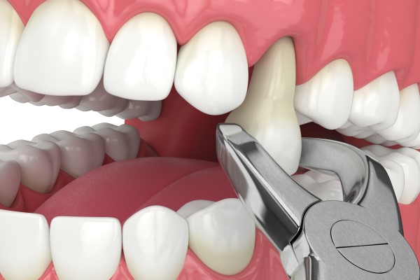 Why Is a Dental Filling Considered a Direct Dental Restoration? - Gladstone  Family Dental And Implants Gladstone Missouri